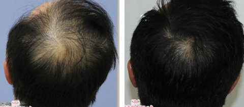 毛髪再生メソセラピーの症例写真 施術ビフォー6ヶ月後