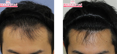 湘南AGAクリニック仙台院での自毛植毛の症例写真