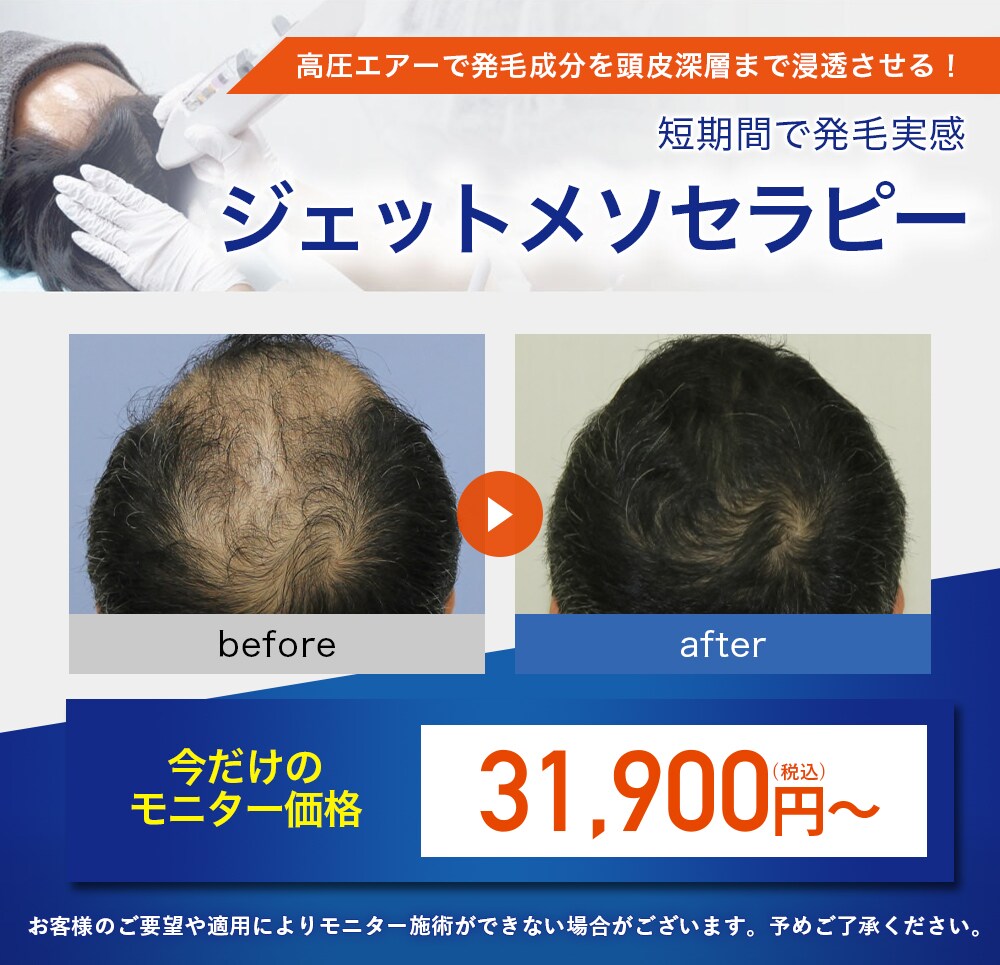 ノンシェーブン植毛 モニター