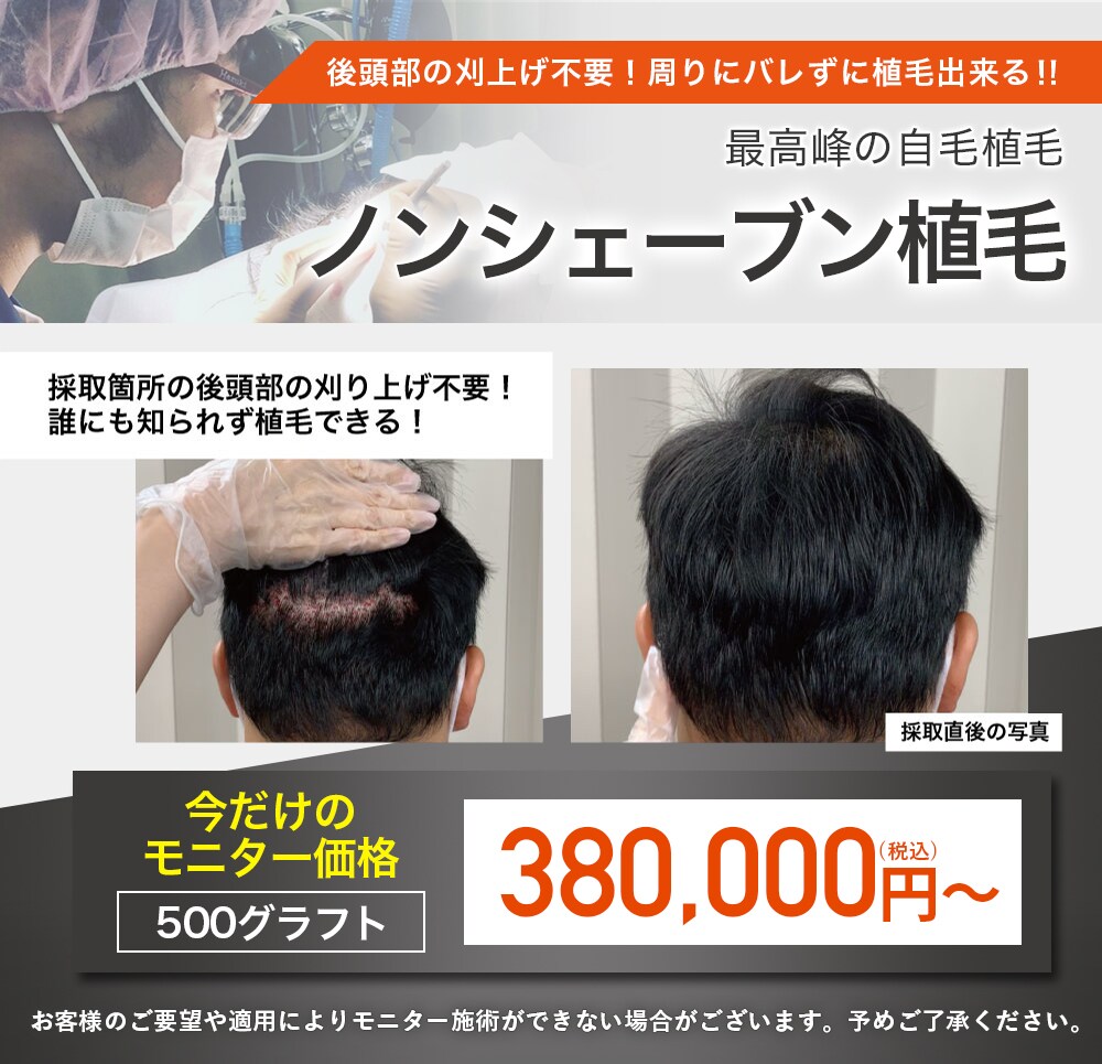 ノンシェーブン植毛 モニター