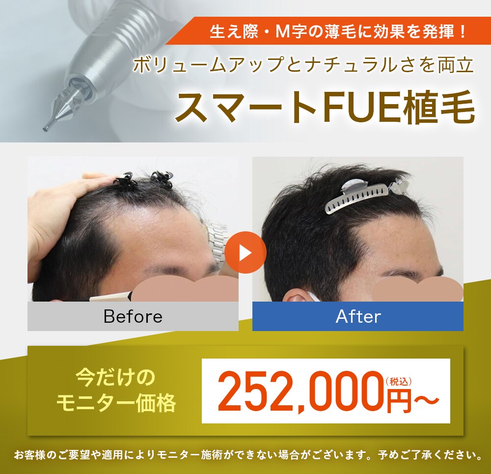 スマートFUE植毛モニター募集