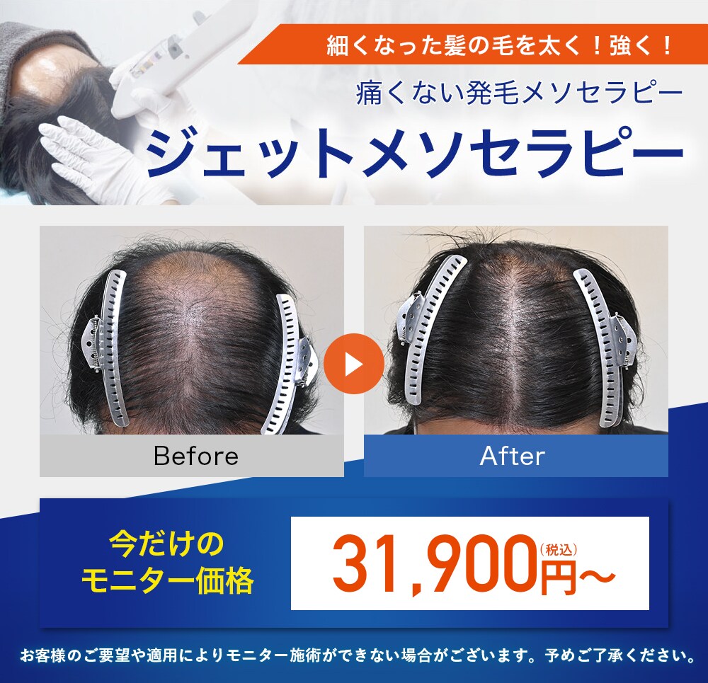 ジェットメソセラピーモニター募集