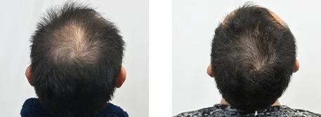 AGA治療薬+ジェットメソの症例写真ビフォーアフター