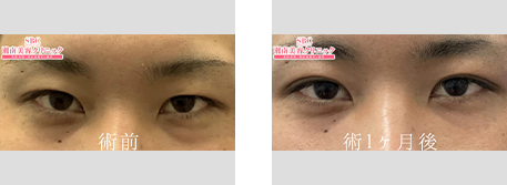 週末二重術の症例写真ビフォーアフター