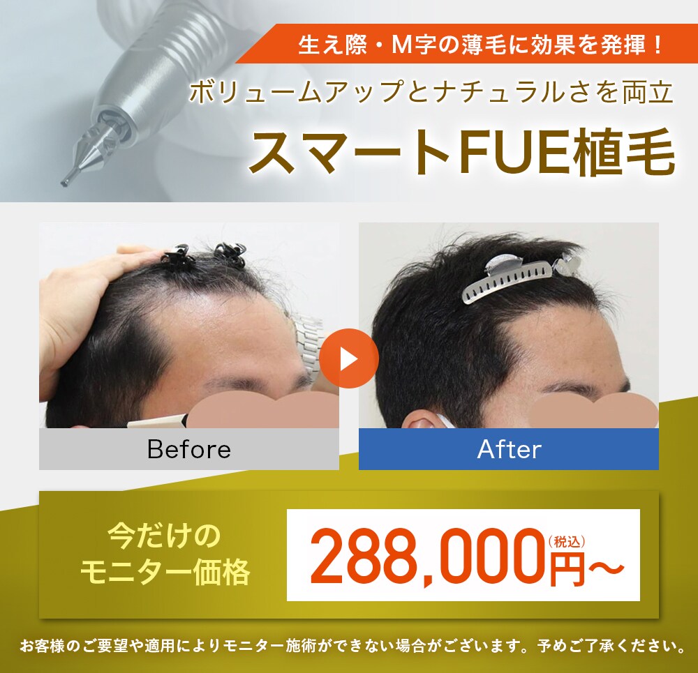 スマートFUE植毛モニター募集