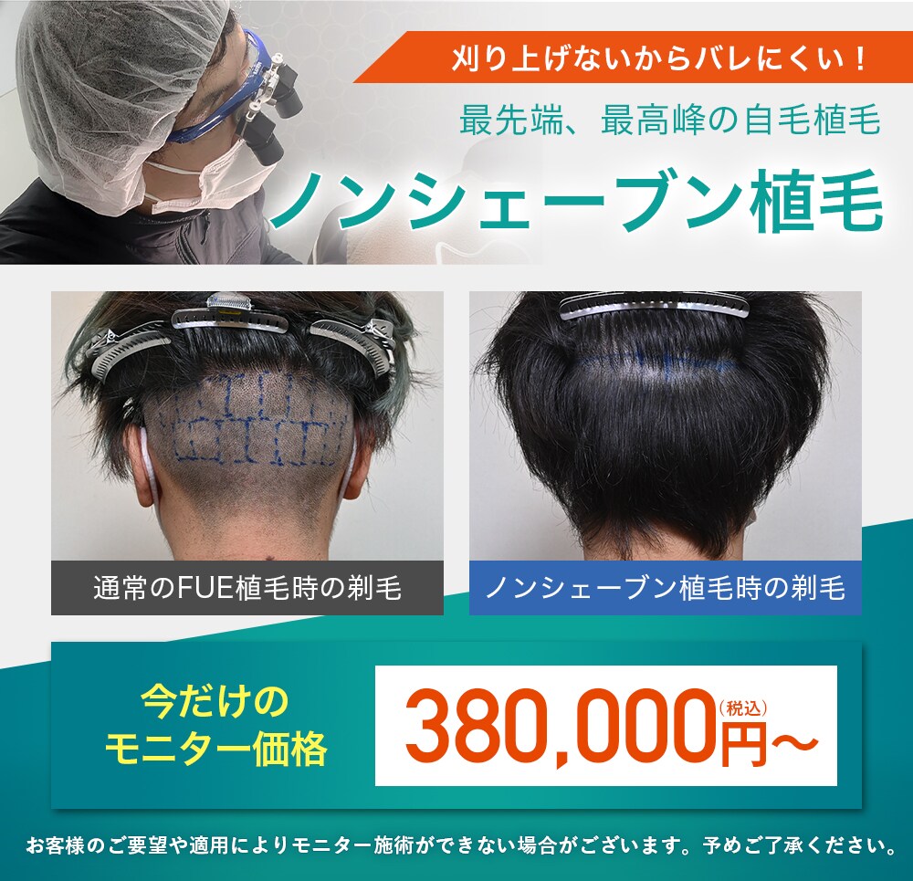 ノンシェーブ植毛モニター募集