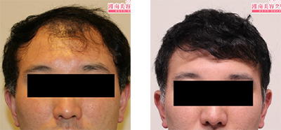 湘南AGAクリニック新宿南口院（東京）でのAGA治療薬の症例写真