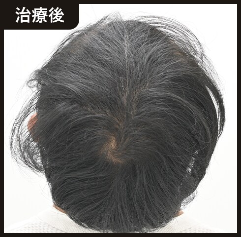 20代男性 1ヶ月後