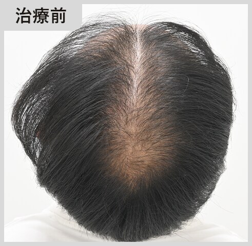 20代男性 術前