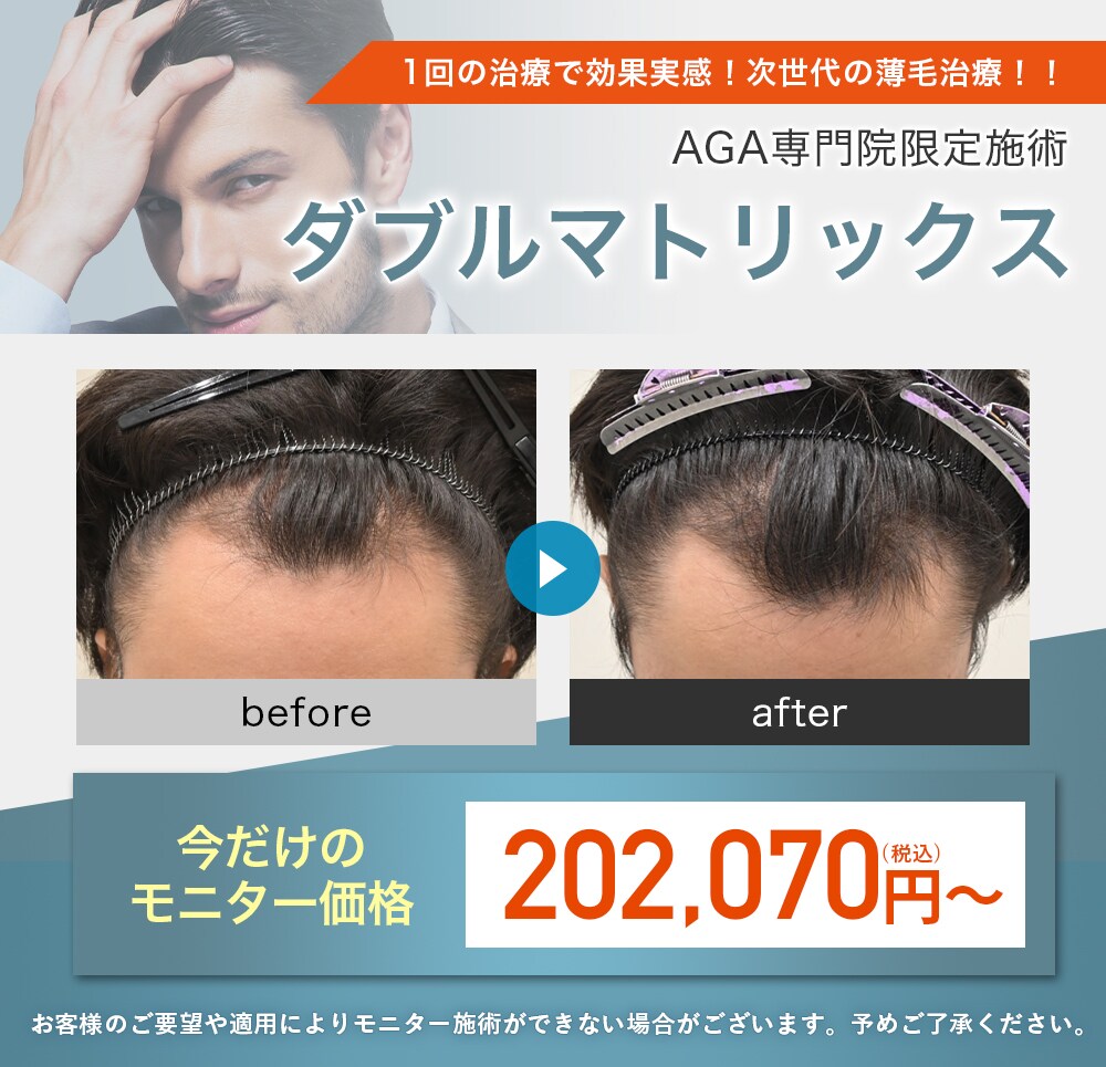 湘南AGAクリニック横浜院のモニター募集　ダブルマトリックス