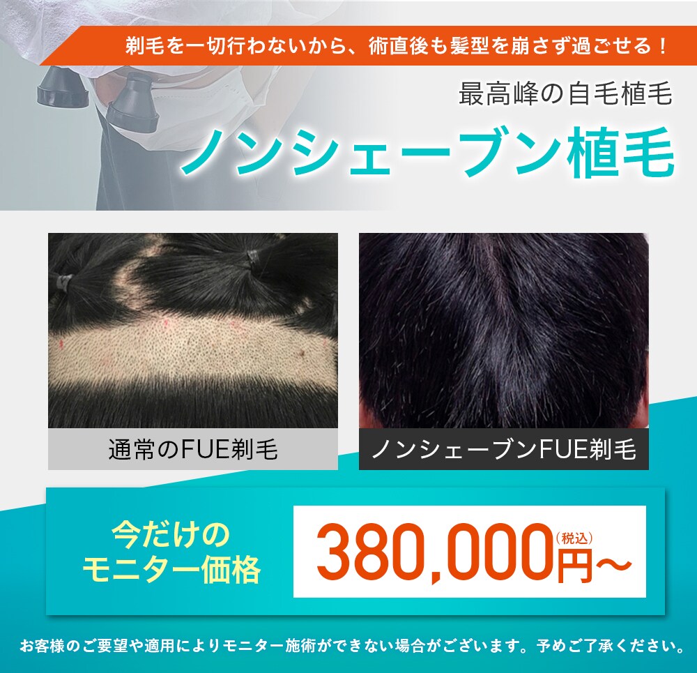 湘南AGAクリニック横浜院のモニター募集　ノンシェーブン植毛
