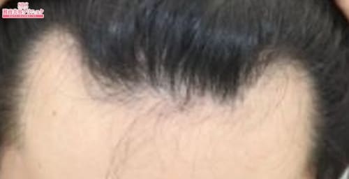 術前