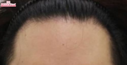 治療開始後12ヶ月