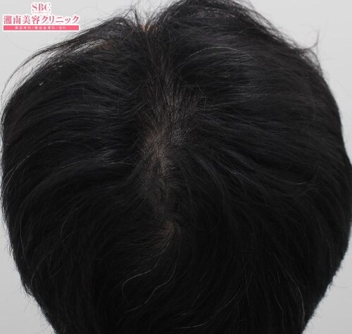 治療開始後5ヶ月
