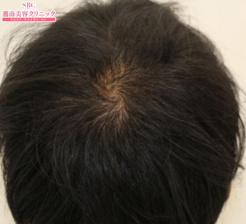 治療開始後3ヶ月