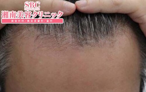術前