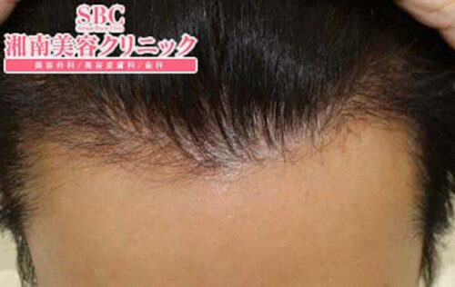 術後6ヶ月