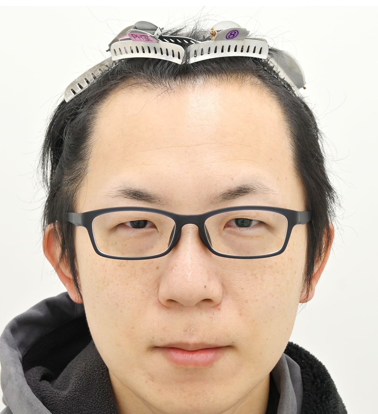 術前