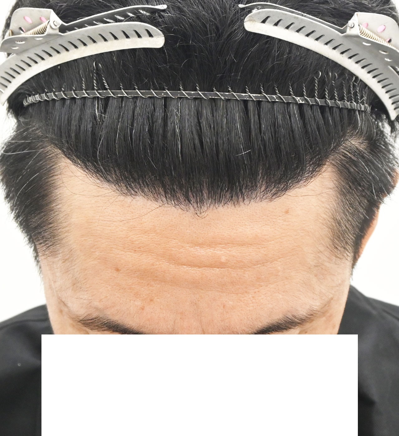 治療開始9ヶ月後