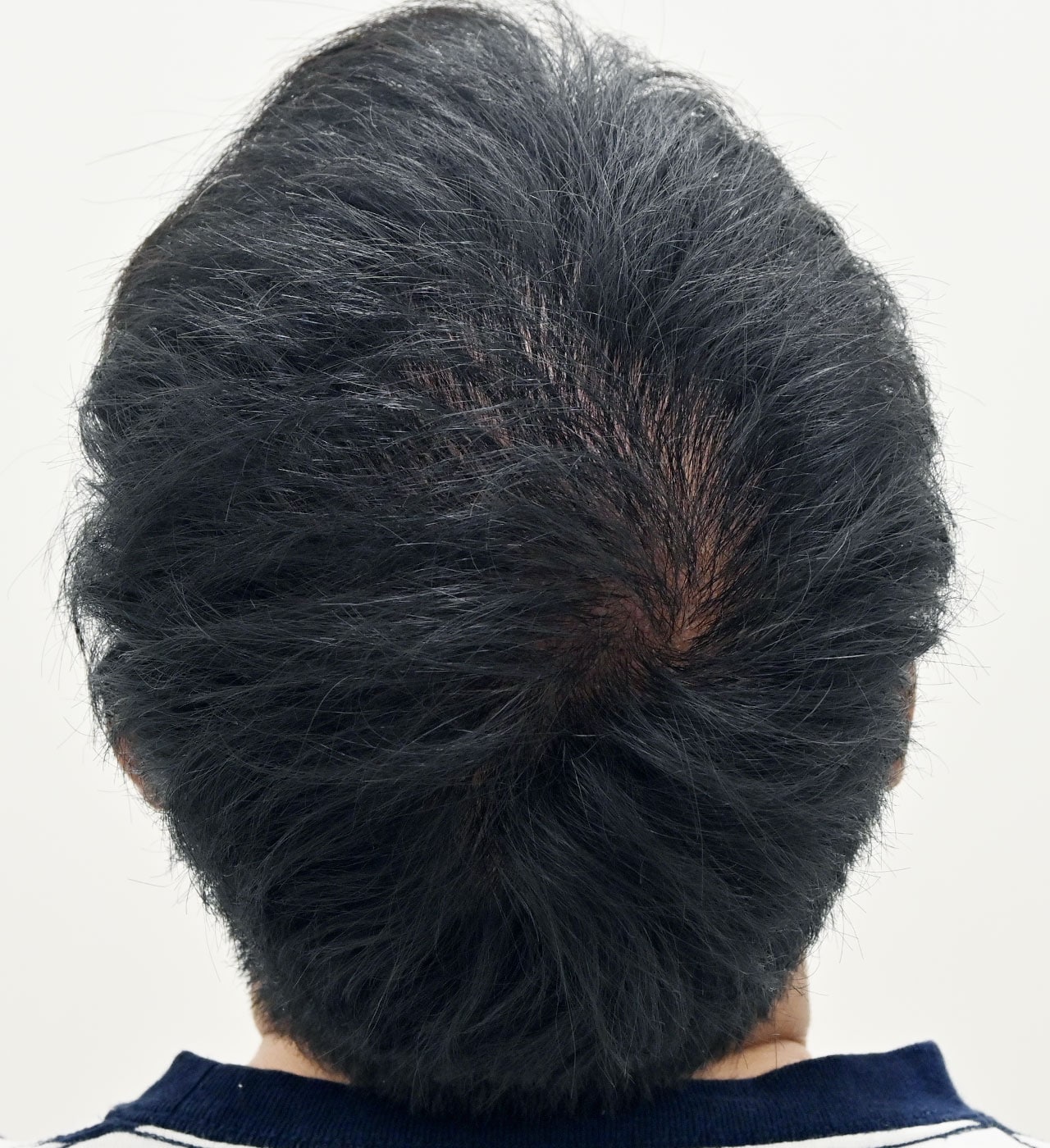 治療開始6ヶ月後