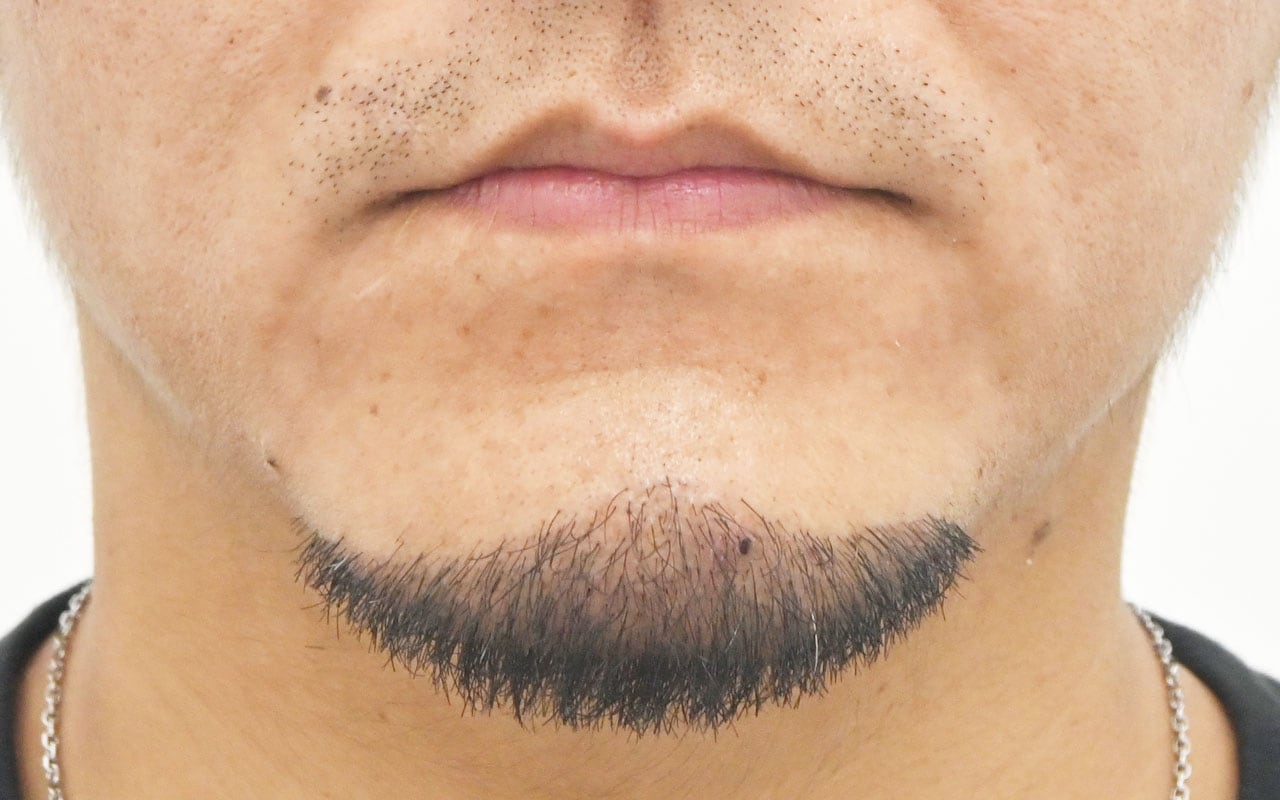 治療開始6ヶ月後