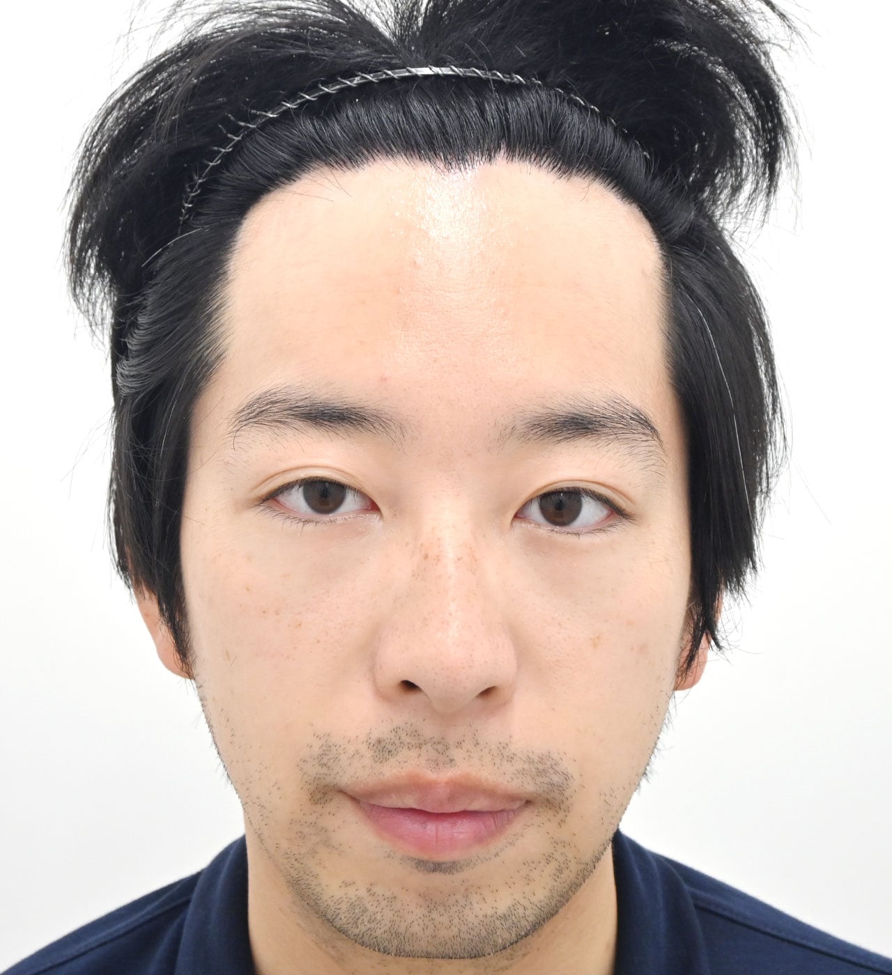 治療開始1年後