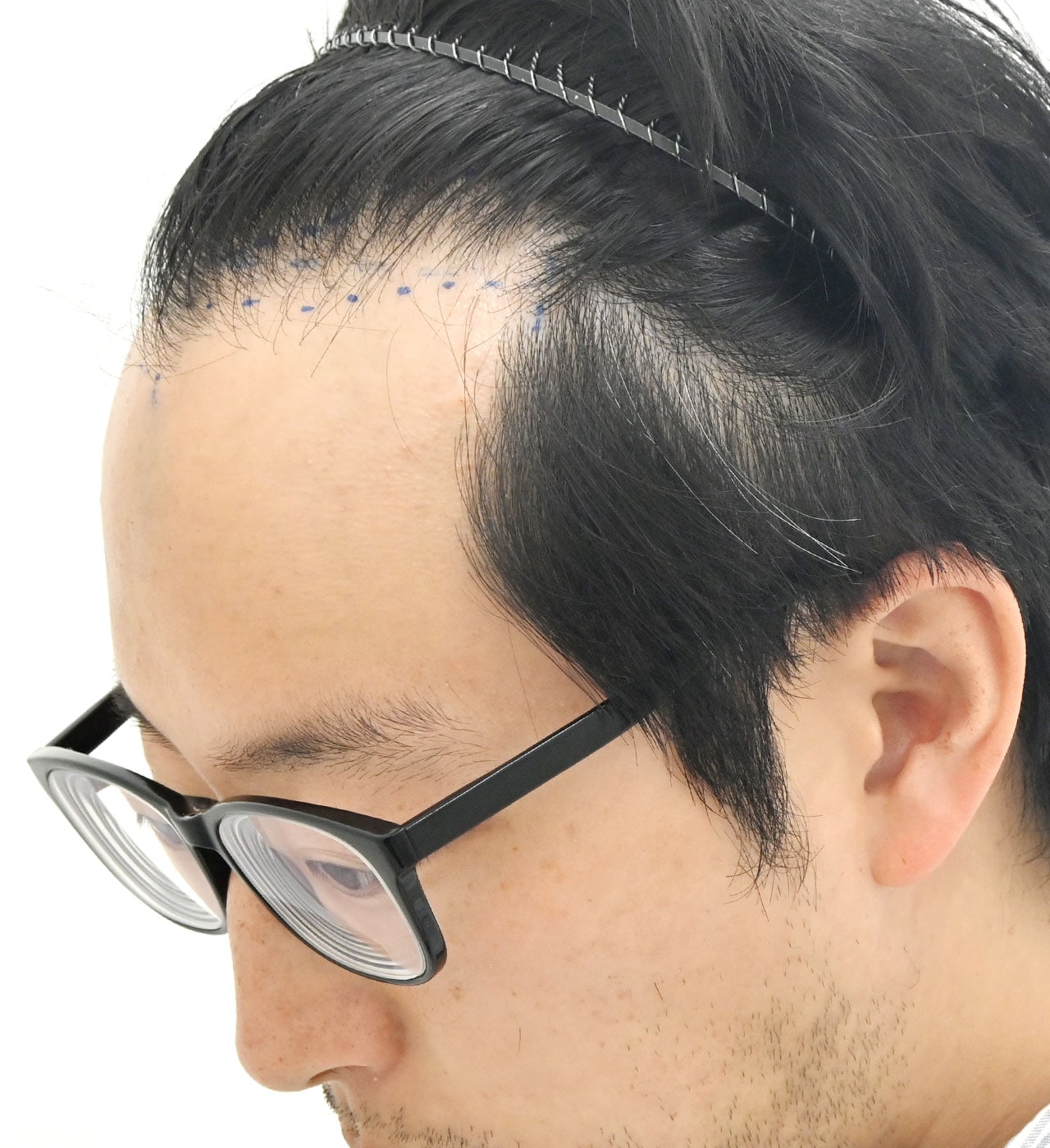 術前
