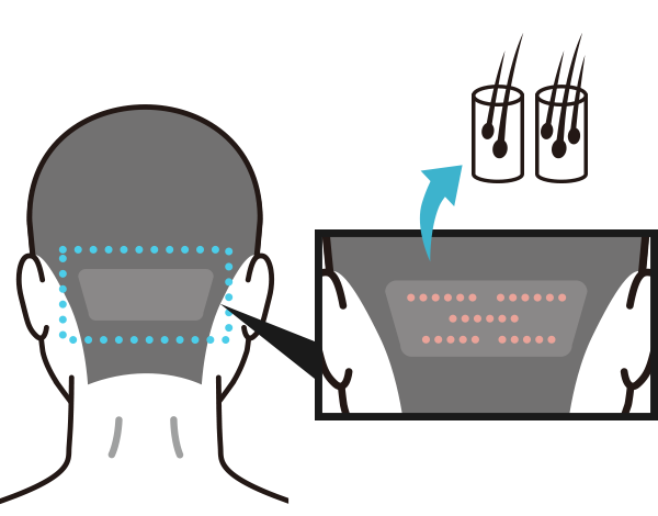 ドナー採取