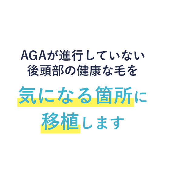 AGAが進行していない後頭部の健康な毛を気になる箇所に移植します