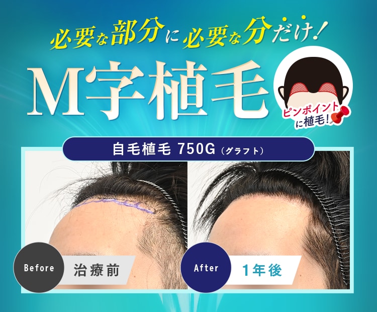 ちょこっとだからリーズナブル!M字植毛