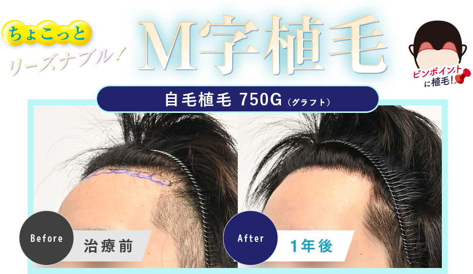ちょこっとだからリーズナブル！M字植毛