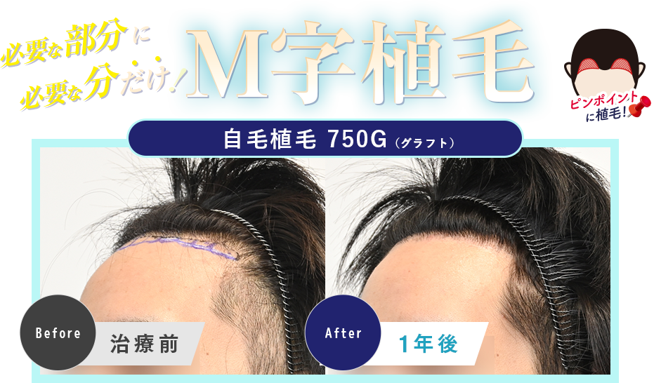 ちょこっとだからリーズナブル！M字植毛
