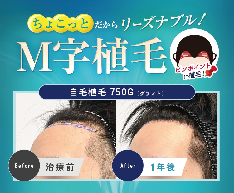 ちょこっとだからリーズナブル!M字植毛