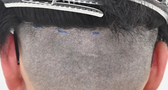 スマートFUE植毛