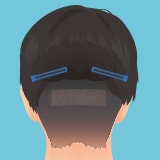 スマートFUE植毛