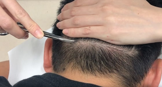 スマートFUE植毛