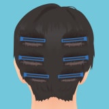 ノンシェーブン植毛