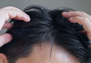 M字植毛はこんな方におすすめ