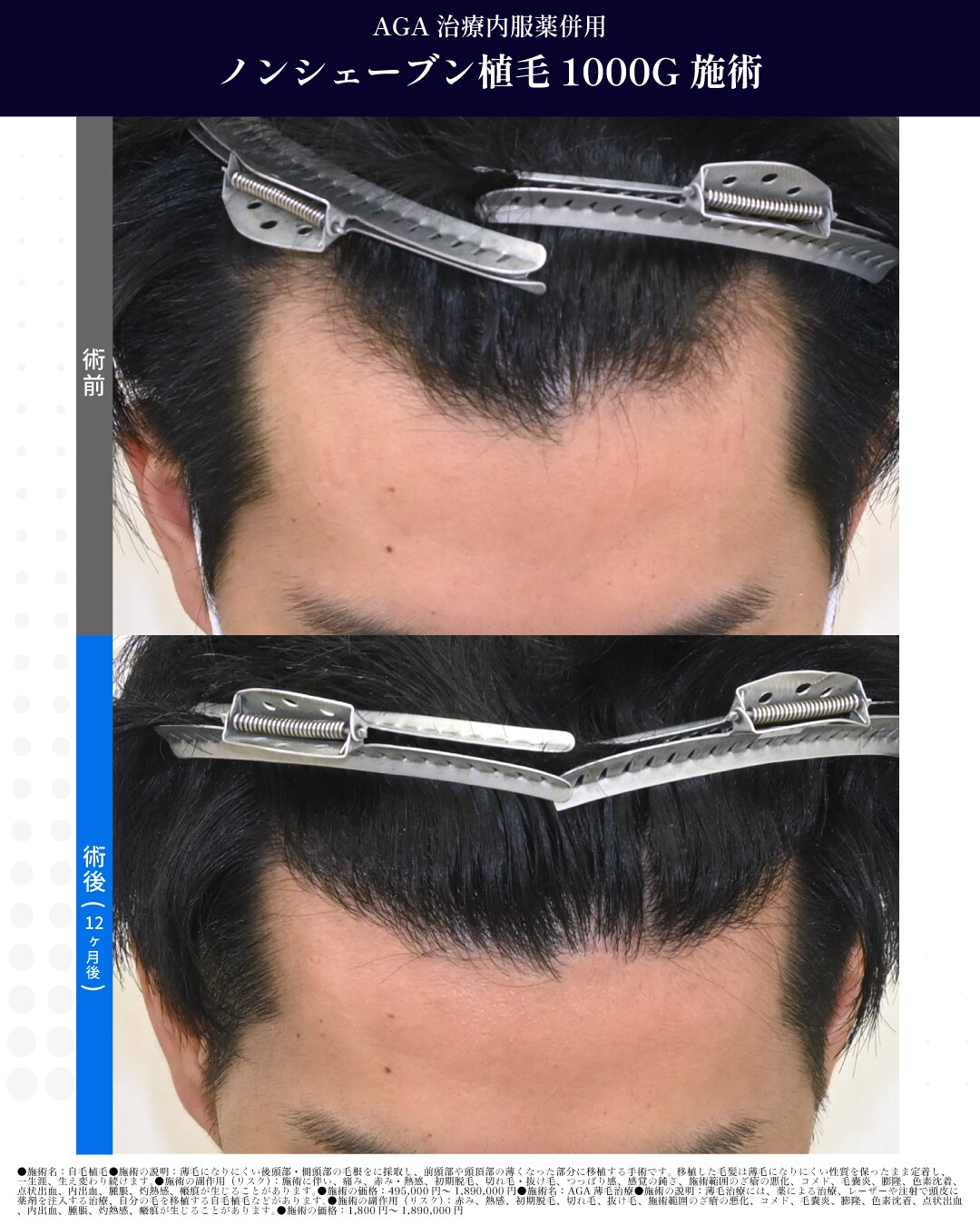 ノンシェーブン植毛　1000G　施術