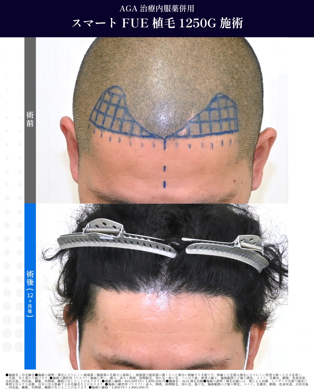 スマートFUE 1250G　施術