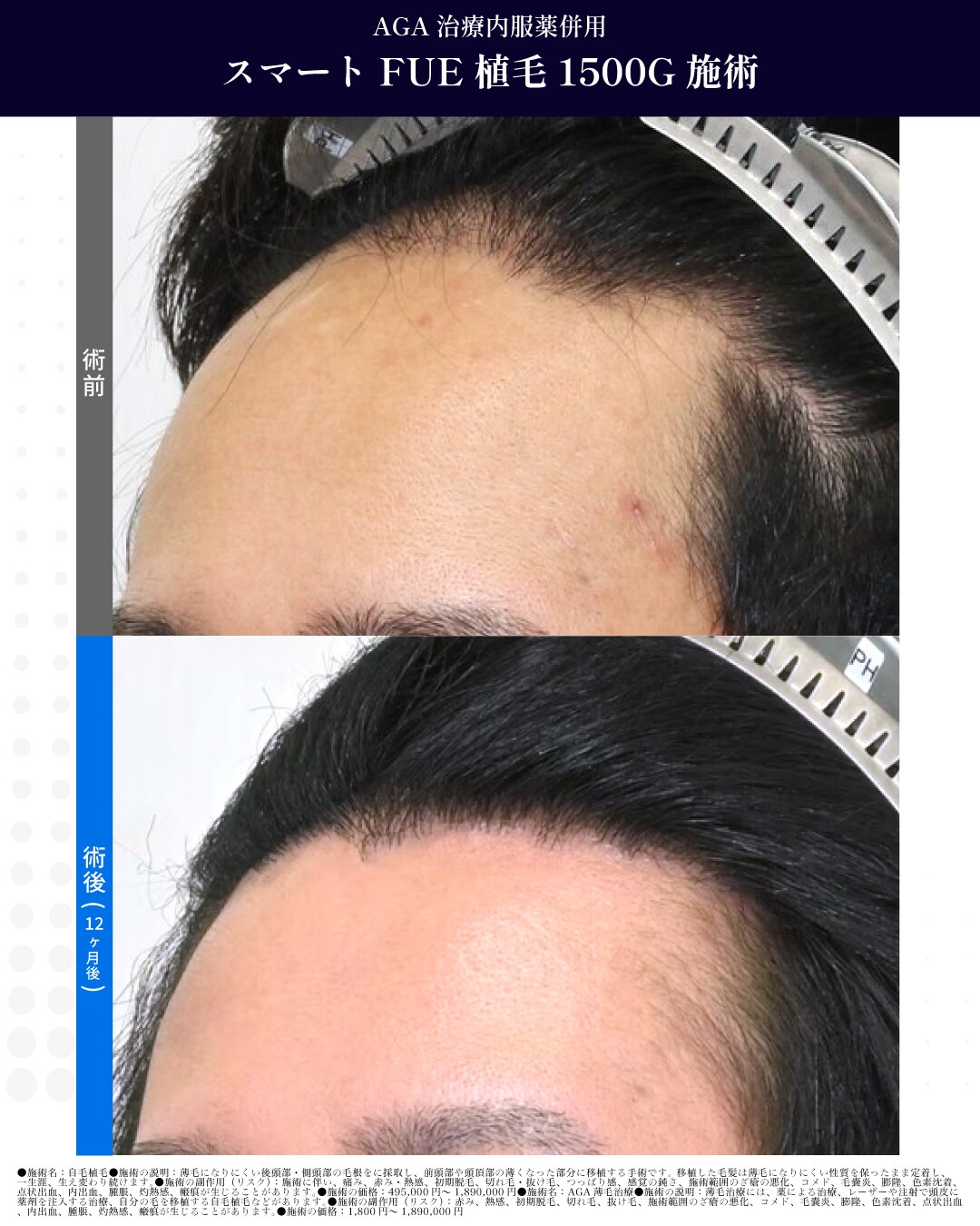 スマートFUE 1500G　施術