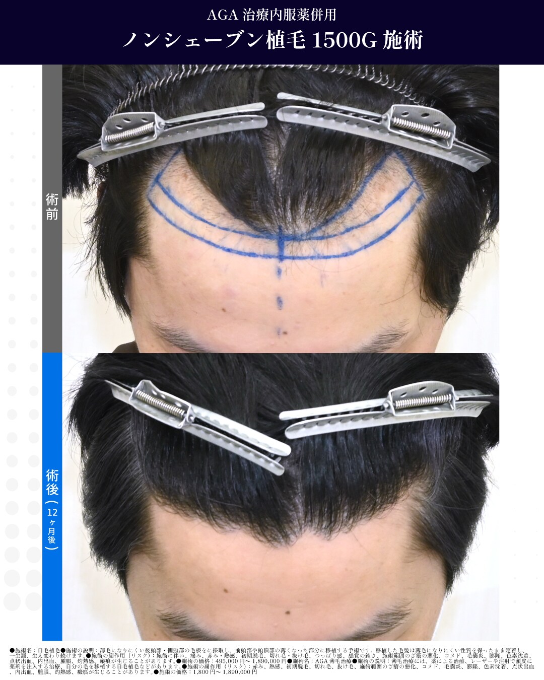 ノンシェーブン植毛　1500G　施術