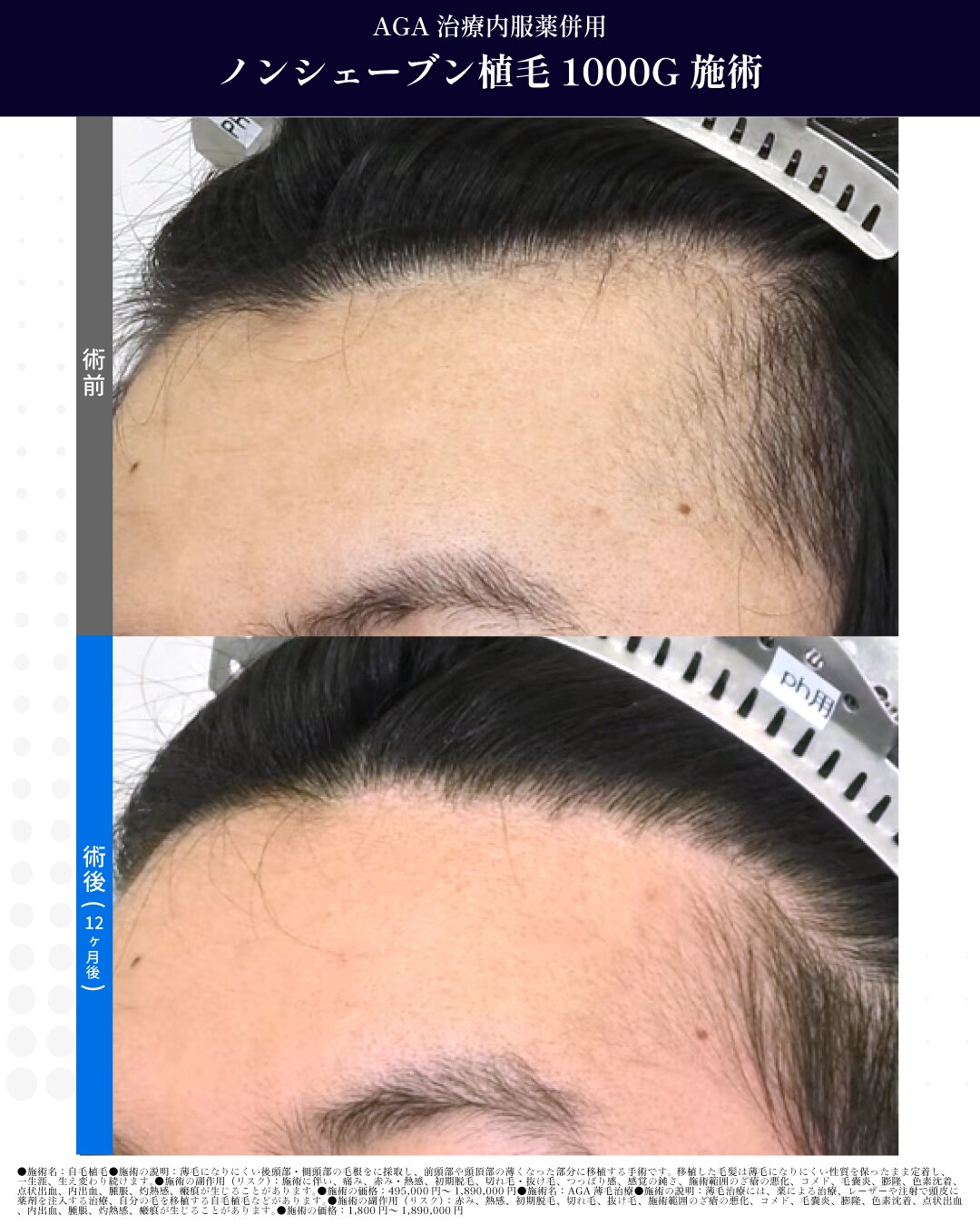 ノンシェーブン植毛　1000G　施術