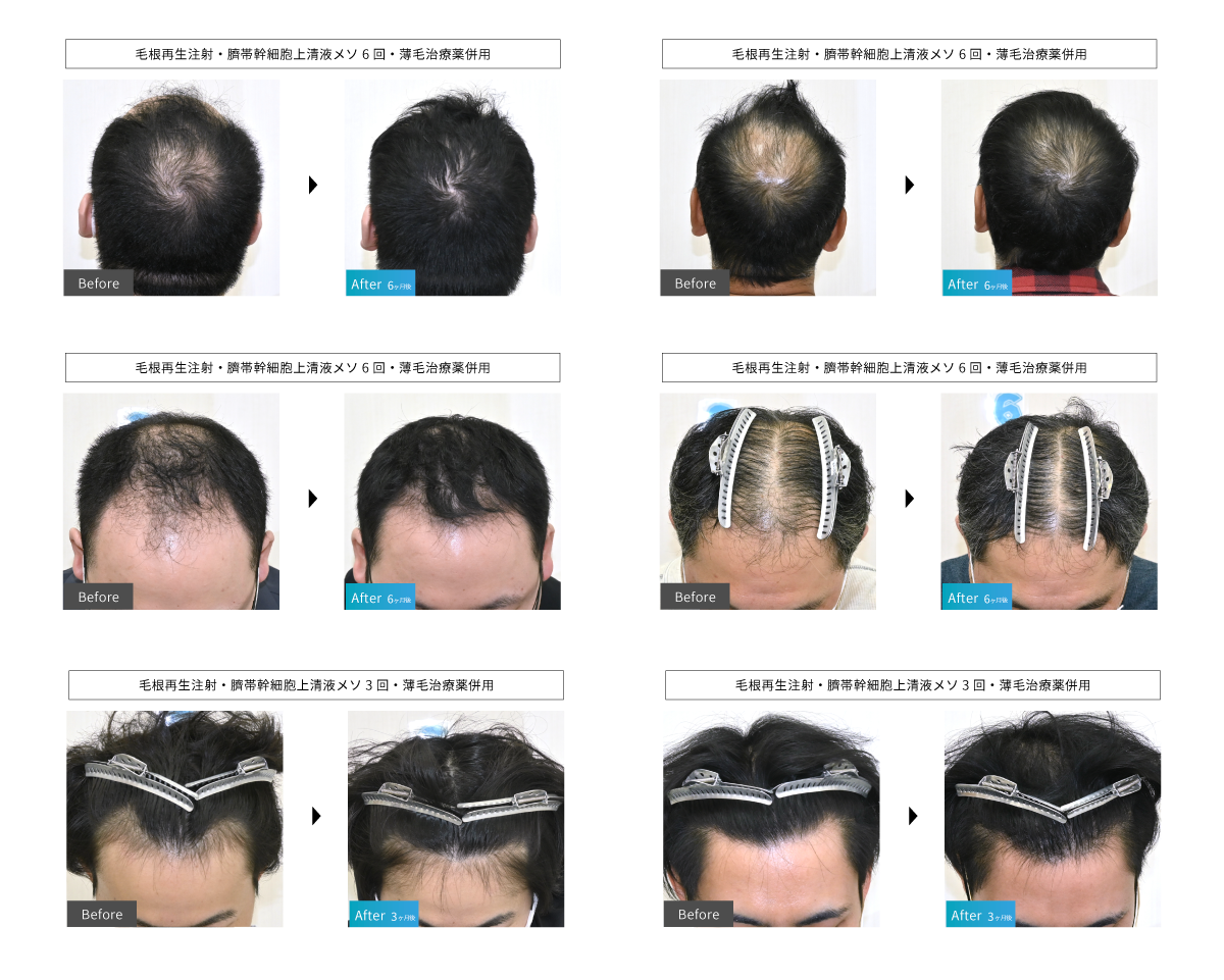 ノンシェーブン植毛 1000G 施術
