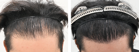 自毛植毛の症例写真ビフォーアフター1
