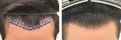 自毛植毛の症例写真ビフォーアフター2