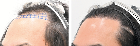 自毛植毛の症例写真ビフォーアフター3