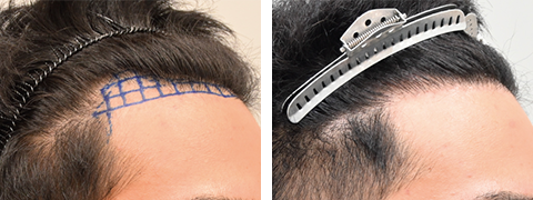 自毛植毛の症例写真ビフォーアフター4