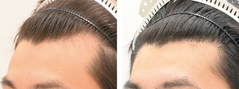 自毛植毛の症例写真ビフォーアフター4