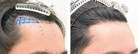 自毛植毛の症例写真ビフォーアフター4